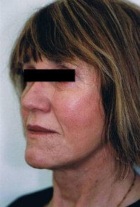 thread face lift after-245