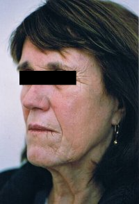 thread face lift before-766
