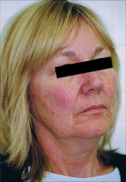 threadlift face side view resize before-695