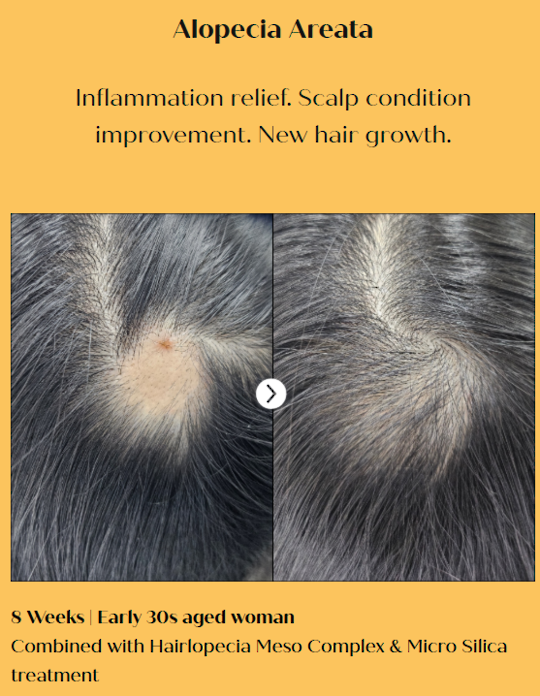 HAIRLOPECIA - Hair Loss Soultions image 6