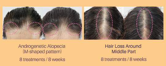 HAIRLOPECIA - Hair Loss Soultions image 2