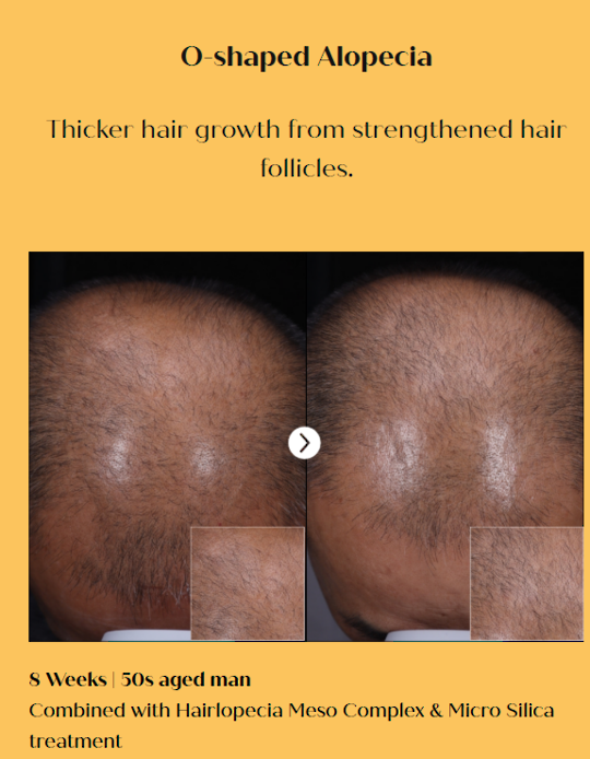 HAIRLOPECIA - Hair Loss Soultions image 5
